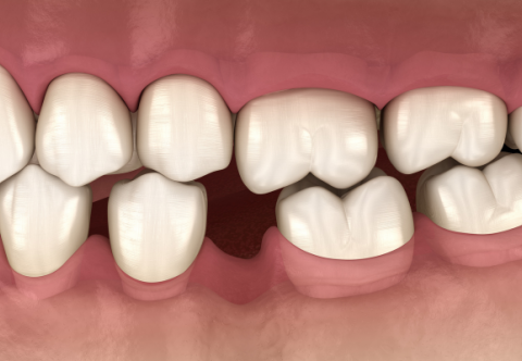 Giải đáp: Bị mất răng lâu năm có trồng Implant được không